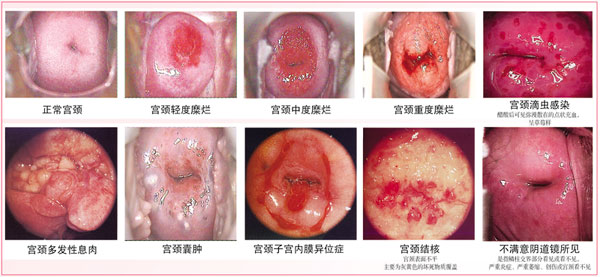 什么是<em>宫颈糜烂</em>?_<em>宫颈糜烂</em>_合肥现代<em>妇科医院</em>