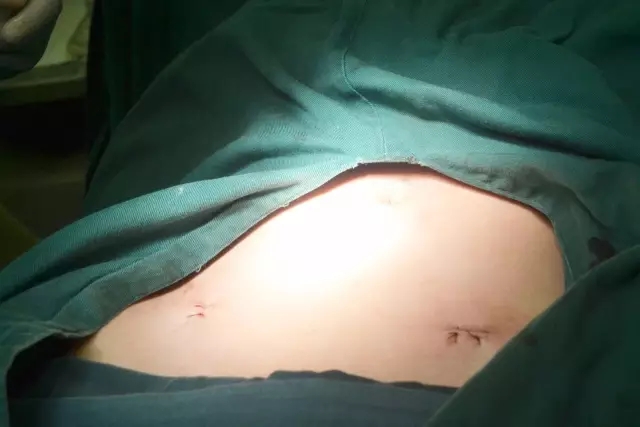 打造妇科微创品牌 合肥现代妇产进入“微”时代